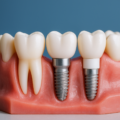 Implanturile dentare: Soluția modernă pentru a înlocui dinții pierduți fără compromisuri